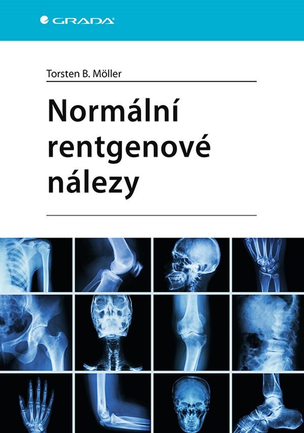 Normální rentgenové nálezy – Möller Torsten B