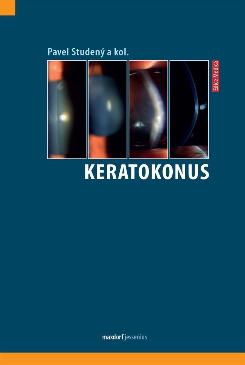 Keratokonus – group of authors