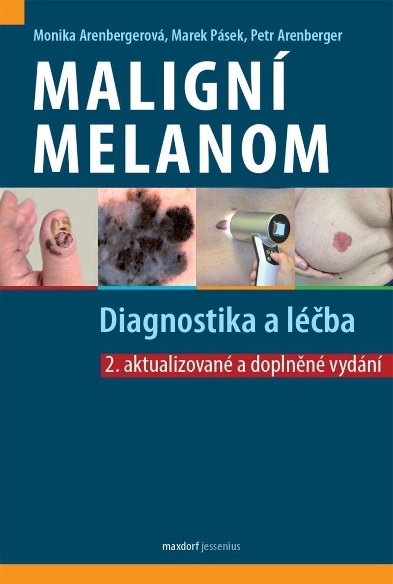 Maligní melanom - Diagnostika a léčba – Arenbergerová Monika