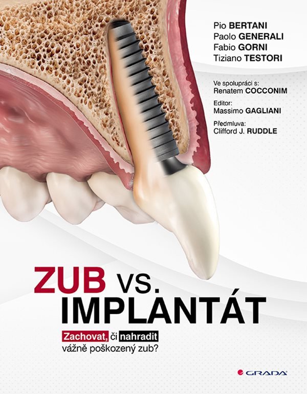 Zub vs implantát - Zachovat či nahradit vážně poškozený zub – group of authors
